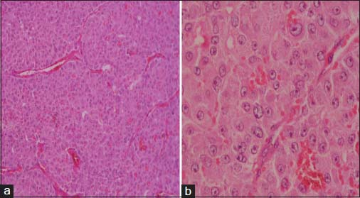 (a) Histology showing tumor cells in nests with abundant eosinophilic cytoplasm (H and E ×100). (b) High power showing large nuclei with prominent nucleoli (H and E ×400)