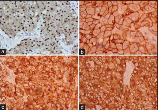 The tumor cells show strong positivity to androgen receptor (a), human epidermal growth factor receptor 2 (b), epithelial membrane antigen (c), and gross cystic disease fluid protein-15 (d) (×400)