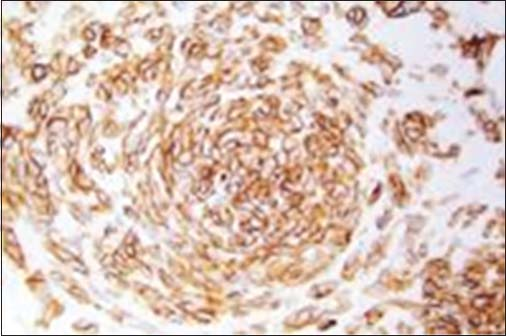 Immunohistochemistry showing CD117 positivity