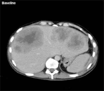 Pretreatment liver metastasis