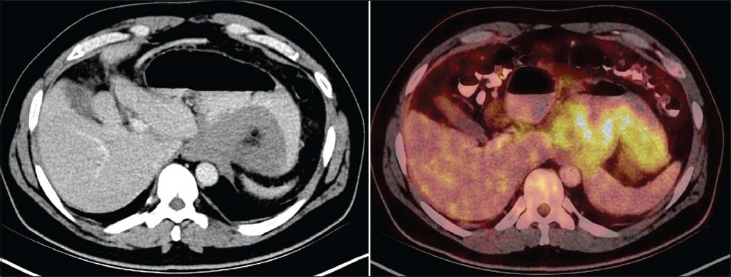 Axial diagnostic computed tomography images show circumferential mass like thickening in the region of gastric fundus. 18-F Fluorodeoxyglucose positron emission tomography-computed tomography shows a metabolically active stomach lesion