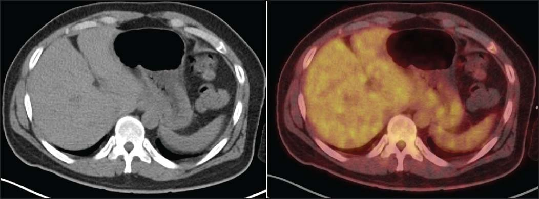 Axial diagnostic computed tomography images show residual mild wall thickening involving fundus and proximal body along lesser and greater curvature of the stomach (maximum thickness 1.4 cm, SUV max 3.3) with heterogeneous tracer uptake