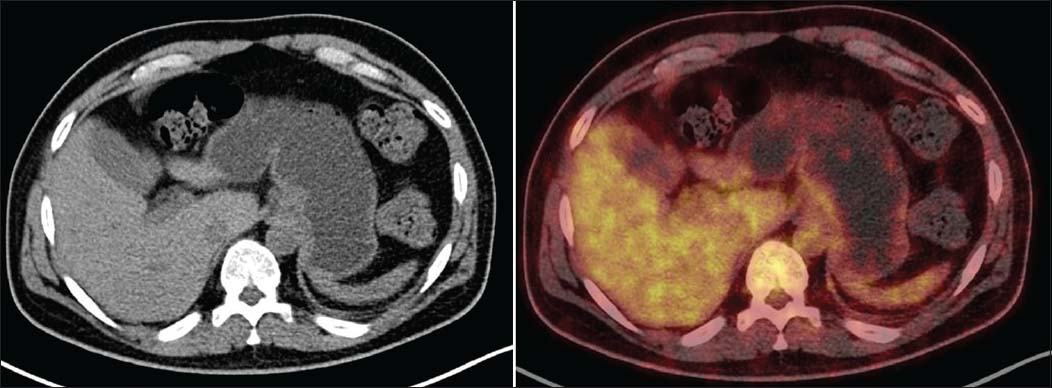 Axial Diagnostic computed tomography images shows ill-defined wall thickening involving fundus and proximal body along lesser and greater curvature of the stomach (maximum thickness 0.8 cm, SUV max 2.3) with heterogeneous tracer uptake
