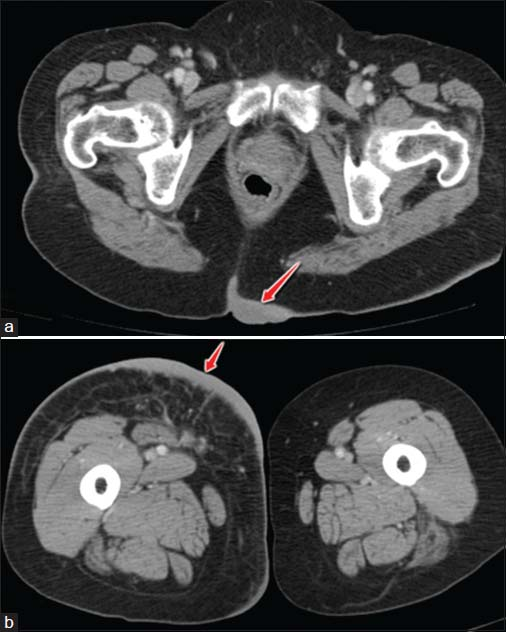 (a) Axial contrast-enhanced computed tomography image showing tumorous nodular thickening of the skin and subcutaneous fat at the region of gluteal cleft (arrow). (b) Axial contrast-enhanced computed tomography image showing tumorous nodular thickening of the skin and subcutaneous fat of anteromedial right proximal thigh (arrow) extending posteriorly