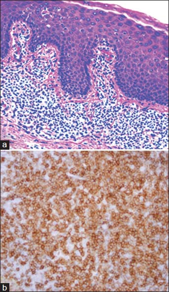 (a): Histopathology of the skin biopsy showing epidermotropism with a dense band-like dermal infiltrate (H and E, ×200). (b) Immunohistochemistry image of the skin biopsy showing positivity for CD3 (×400)