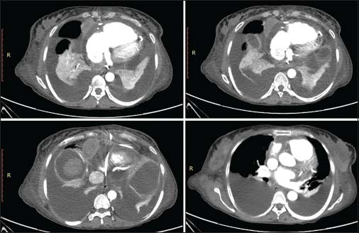 Contrast-enhanced computed tomography chest images showing a well-defined enhancing mass lesion along the right anterolateral aspect of pericardium with moderate pericardial effusion and bilateral pleural effusions with underlying collapse of the lungs