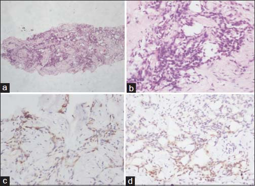 (a and b) Histopathology of mesothelioma. (a) Neoplastic cells arranged in cords, trabeculae, glandular structures (×40). (b) The cells show epithelioid morphology with moderate amount of eosinophilic cytoplasm and round to oval dark nuclei (×400). (c and d) Immunohistochemistry. (c) Calretinin positivity (×400), (d) cytokeratin 5/6 positivity in neoplastic cells (×400)