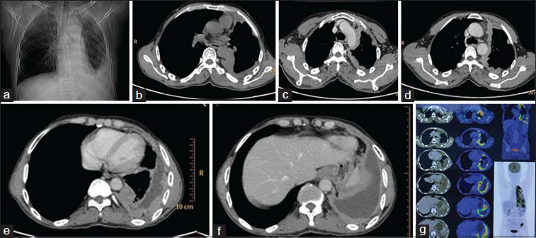Scanogram (a) showing opacity in the periphery of left lower lung zone silhouetting left costophrenic angle, left dome diaphragm, nonenhanced computed tomography axial image (b) showing peripheral nodular pleural thickening which is showing heterogeneous enhancement in contrast-enhanced computed tomography images (c-f) with pleural effusion. Positron Emission tomography images (g) showing metabolically active heterogeneously enhancing thickening with nodularity involving the mediastinal, costal, and diaphragmatic left pleura with loculated areas of effusion at places