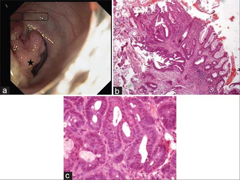 Colonoscopy image. (a) Showing a nodular, friable polypoidal growth (Black star) in descending colon. (b) Normal colonic mucosa in transition to a lesion in the lamina propria infiltrating the muscularis mucosae (H and E, ×40). (c) Closely packed glands lined by pseudostratified layers of cuboidal to columnar cells showing nuclear pleomorphism and hyperchromasia (H and E, ×400)