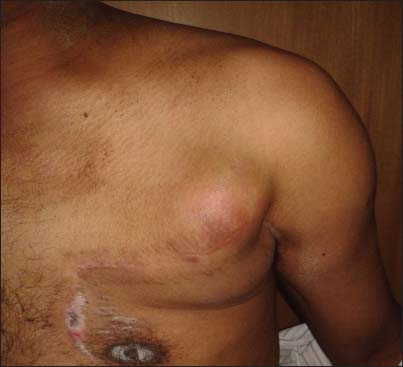 Swelling on the left chest wall scar (pectoralis major myocutaneous donor site). Scar of previous surgery of left neck is also seen