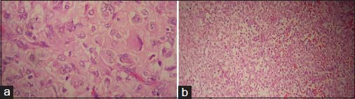 (a) Sections from primary tumor show undifferentiated tumor cells with polygonal cell vesicular nuclei and prominent nucleoli (H and E, ×400). (b) Implantation tumor show undifferentiated tumor cells with focal chondroid matrix (H and E, ×200)