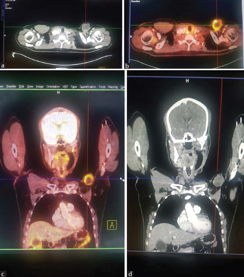 (a) Contrast-enhanced computed tomography thorax showing solid-cystic mass at left chest wall. (b) 18Fluorodeoxy glucose positron emission tomography-computed tomography showing fluorodeoxy glucose-avid mass at left chest wall. (c) 18Fluorodeoxy glucose positron emission tomography-computed tomography showing solid-cystic mass at left chest wall. (d) Contrast-enhanced computed tomography thorax showing solid-cystic mass at the left chest wall