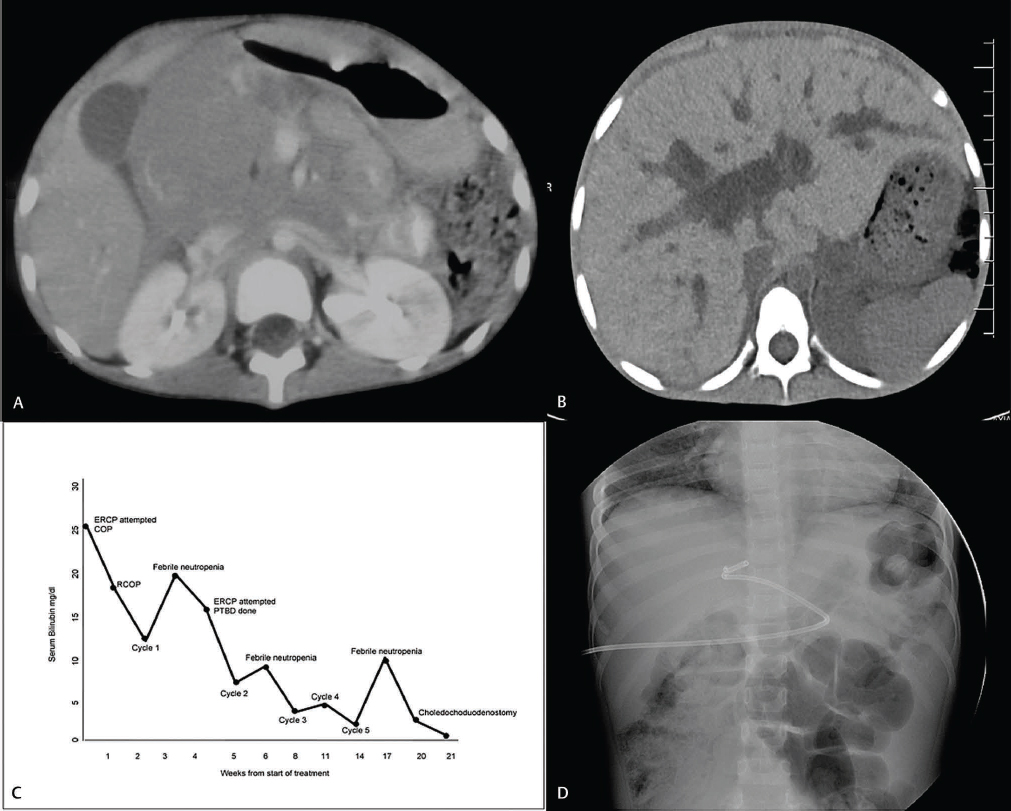 Fig. 1 (A) Computed tomography of the abdomen showing large lobulated mass near pancreatic head, causing abrupt cutoff of distal common bile duct. (B) Computed tomography of abdomen showing dilated intrahepatic biliary radicals post first cycle of chemotherapy. (C) Serum bilirubin trend during treatment. (D) Percutaneous biliary drainage, catheter could not be negotiated beyond common bile duct. COP, cyclophosphamide, vincristine, prednisolone; ERCP, endoscopic retrograde cholangiopancreatogram; PTBD, percutaneous transhepatic biliary drainage; RCOP, rituximab, cyclophosphamide, vincristine, prednisolone.