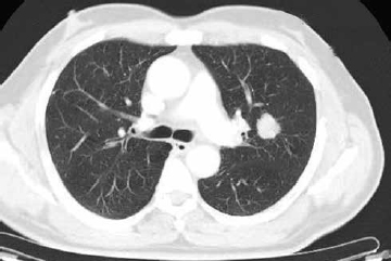 Fig. 1 CECT of the chest showing parahilar irregular, spiculated, enhancing soft tissue mass lesion in the superior lingular segment of the left upper lobe. CECT, contrast-enhanced computed tomography.