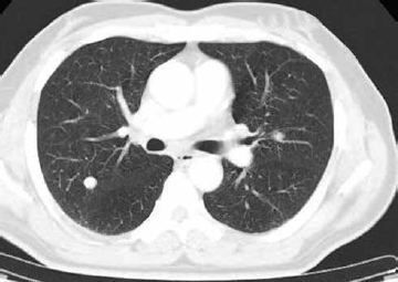 Fig. 2 CECT of the chest showing a metastatic lesion in the posterior segment of the right upper lobe in the contralateral lung. CECT, contrast-enhanced computed tomography.