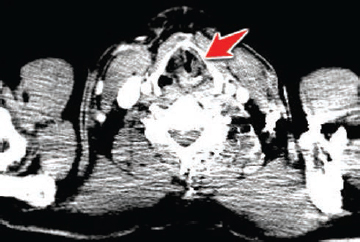 Fig. 3 CECT at the level of vocal cords demonstrating medialization of the left vocal cord with ipsilateral enlargement of the laryngeal ventricle and pyriform sinus suggesting left vocal cord (arrow) palsy. CECT, contrast-enhanced computed tomography.
