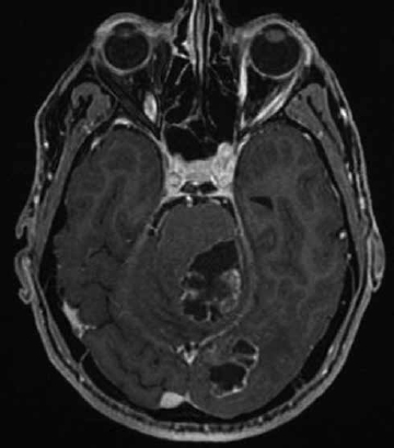 Fig. 4 CEMR of the brain demonstrating thick, ring-enhancing lesions in the left occipital lobe and left cerebellar hemisphere encroaching into the middle cerebellar peduncle with prominent surrounding edema and mass effect on the pons. CEMR, contrast- enhanced magnetic resonance image.