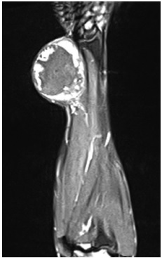 Fig. 2 Magnetic resonance imaging showing a lesion suggestive of peripheral nerve sheath tumors in the median nerve.