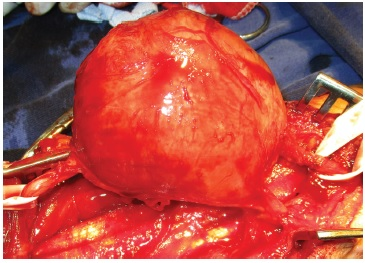 Fig. 3 Tumor resection.