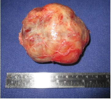 Fig. 4 Tumor resection.