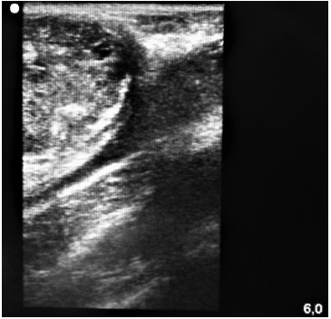 Fig. 5 Intraoperative ultrasound.