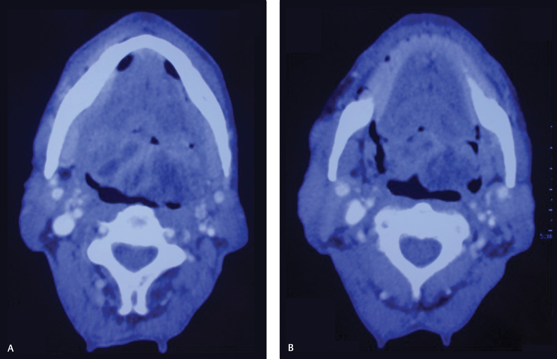 Fig. 1 (A) CECT face and neck (axial view 1), (B) CECT face and neck (axial view 2).