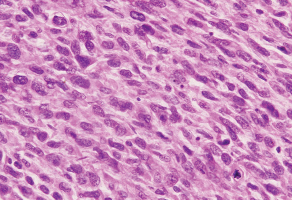 Fig. 2 Sheets of spindle cells showing moderate pleomorphism and high mitosis (hematoxylin and eosin: ×600).