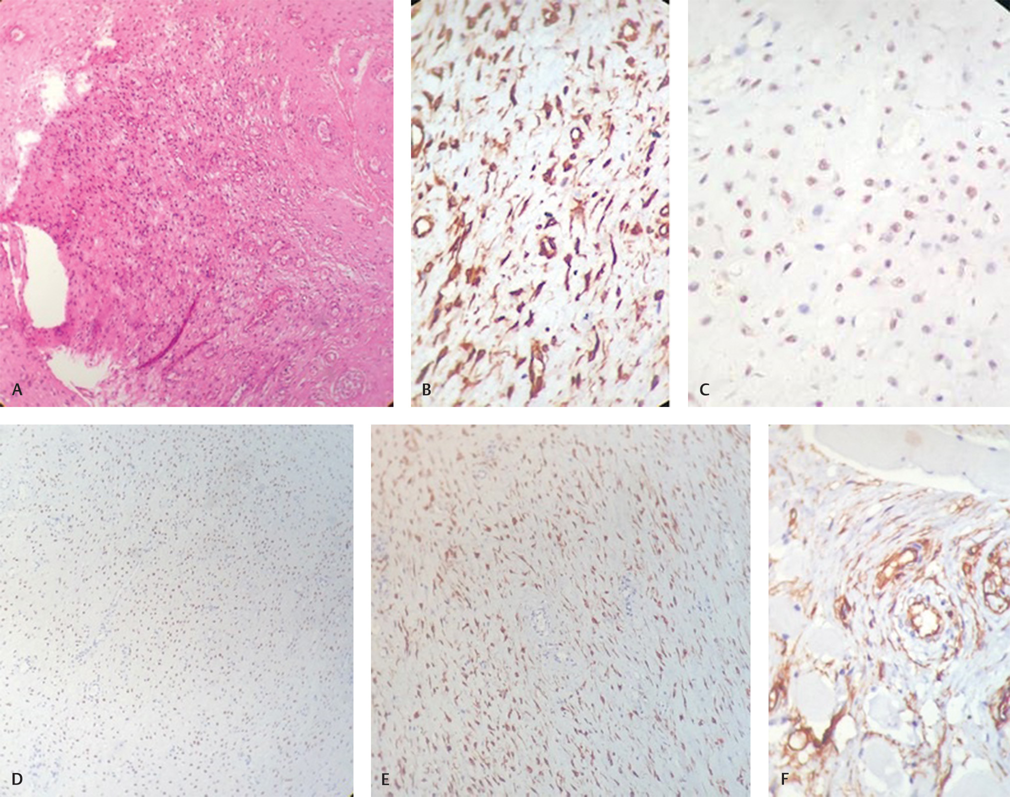 Fig. 1 (A) Section showing low-to-moderate cellularity with small, stellate, and spindled cells embedded in loosely collagenous myxedematous matrix containing scattered vessels of varying calibre. No mitosis seen (H&E, ×40). (B) Immunohistochemical analysis showed that tumor cells are positive for vimentin. (C) Estrogen receptor immunostatin is positive in tumor cells. (D) Progesterone receptor (PR) immunostatin is positive in tumor cells. (E) Desmin immunostatin is positive in tumor cells. (F) Tumor cells are negative for CD-34 marker.