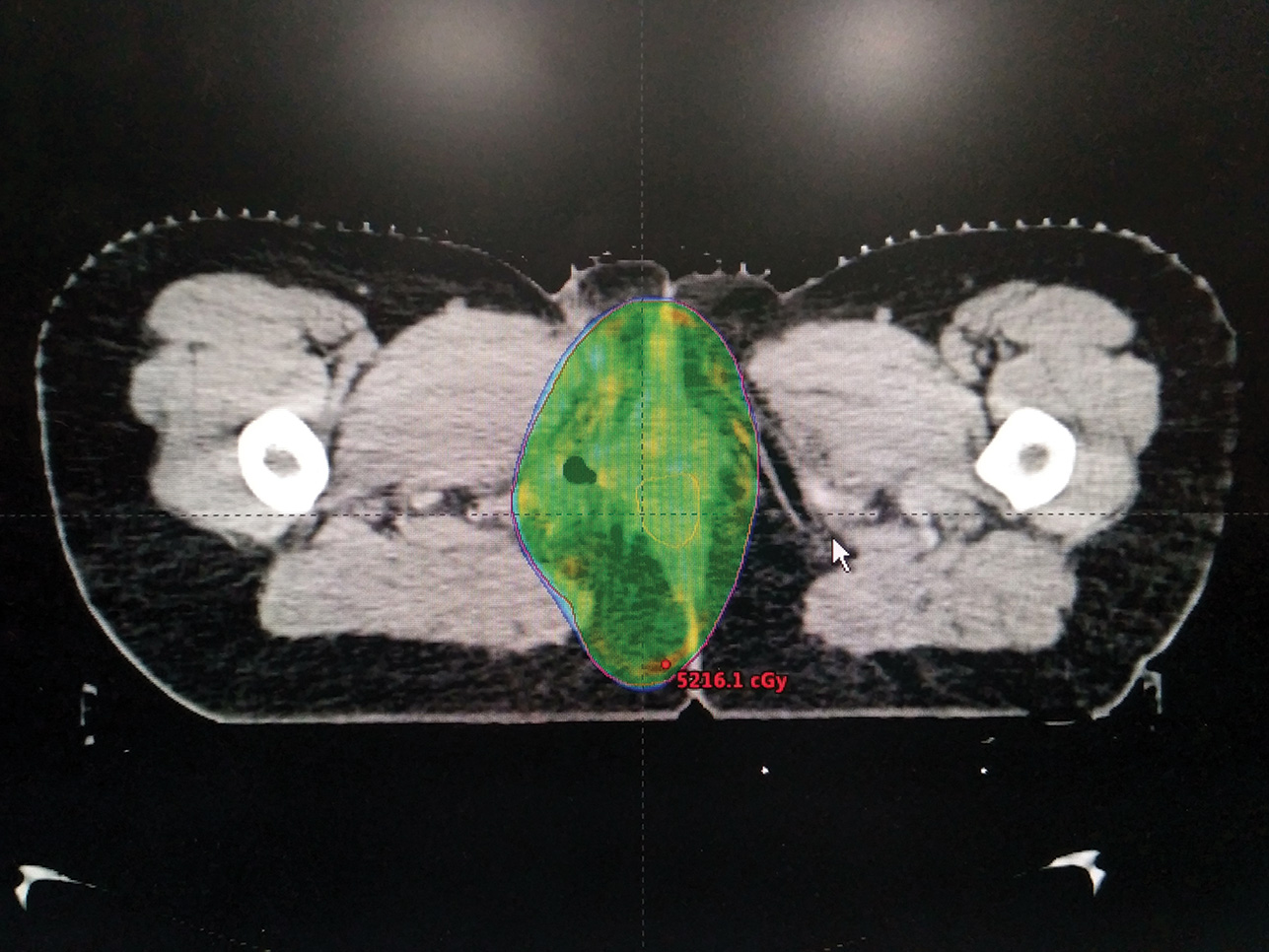 Fig. 2 Axial image of a VMATplan showing optimal coverage of the planning target volume by 95% of the prescribed dose. VMAT, volumetric modulated arc therapy.