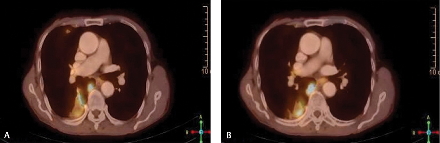 Fig. 1 (A, B) PET-CT fusion images showing well-defined fluorodeoxyglucose avid lesion involving apical segment of lower lobe parenchyma of right lung suggestive of metastases. PET-CT, positron emission tomography–computed tomography.