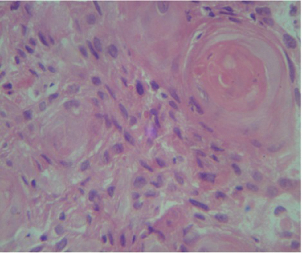 Fig. 2 Biopsy review from breast lesion showing the characteristic “keratin pearl” deposit of invasive moderately differentiated squamous cell carcinoma, not originating from overlying skin.