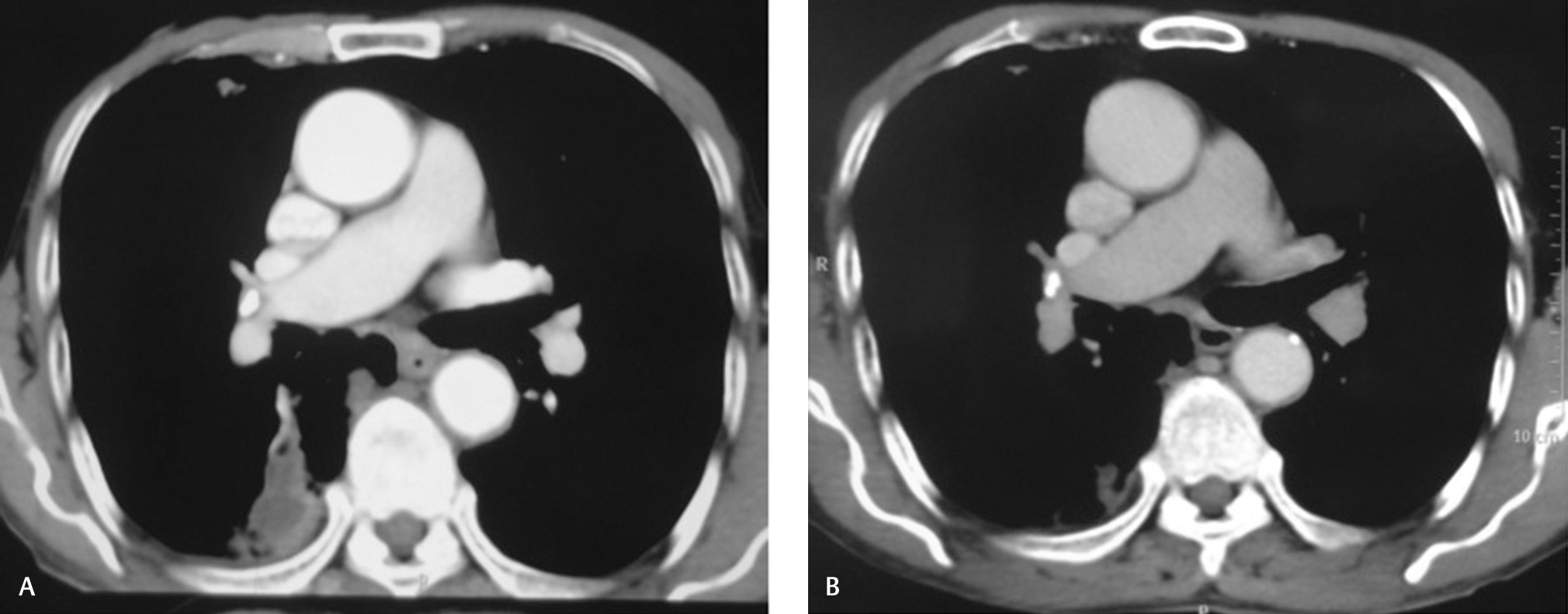 Fig. 3 (A, B) Comparison of CT images at presentation and 6 months posttreatment showing resolution of metastatic lesion involving apical segment of lower lobe parenchyma of right lung. CT, computed tomography.