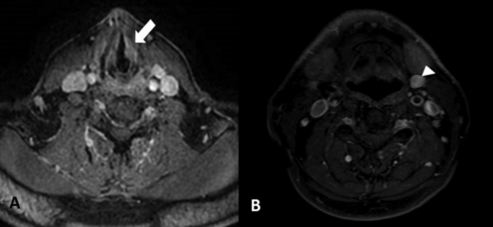 Fig. 2 (A) Preoperative magnetic resonance imaging (MRI) findings, mass lesion on the middle one-third portion of the left vocal cord (white arrow). (B) Preoperative MRI findings (white arrowhead): a jugulodigastric lymph node in the left cervical region in size of 10 x 15 mm.