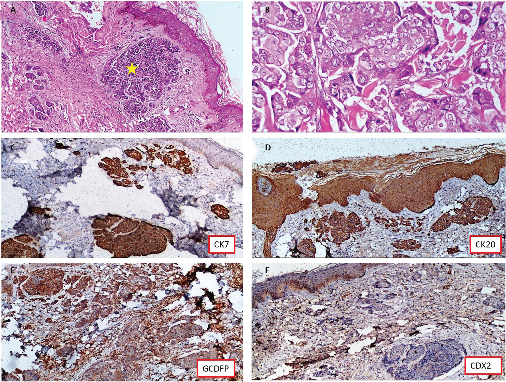 Fig. 2 (A) Dermis shows presence of numerous nests of atypical cells in a fibrocollagenous stroma (yellow star; hematoxylin & eosin [H&E] 100×). (B) Cells are large with high nuclear cytoplasmic ratio, pleomorphic nuclei with prominent nucleoli. No necrosis/mitosis is noted (H&E 400×). (C) Immunohistochemistry (IHC) CK7 (100×). (D) IHC CK20 (100×). (E) IHC GCDFP (100×). (F) IHC CDX2 (100×).