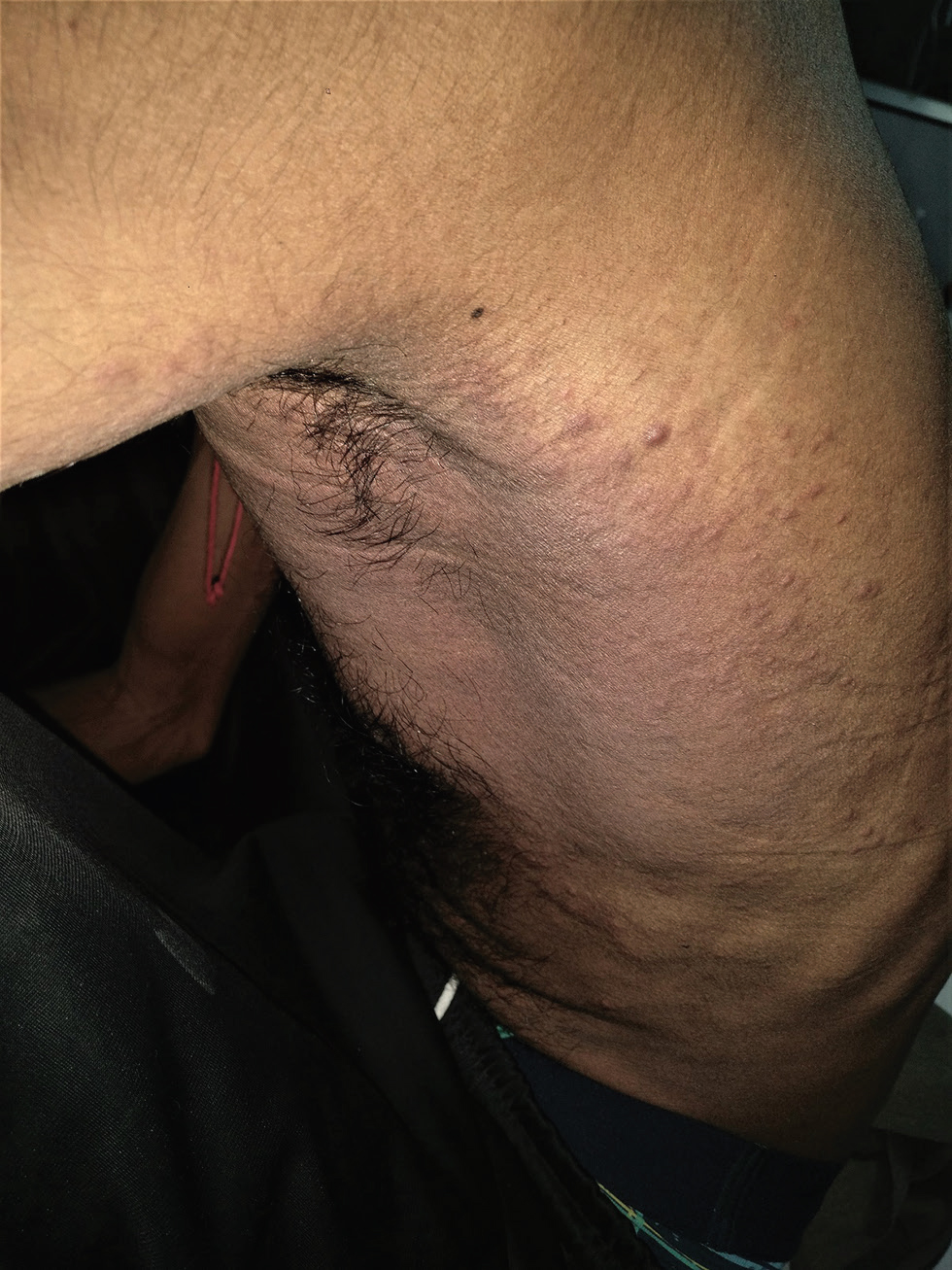 Fig. 3 Case 2: Diffuse erythema and edema over left infra-axillary region extending posteriorly with multiple overlying erythematous papules and plaques are seen.
