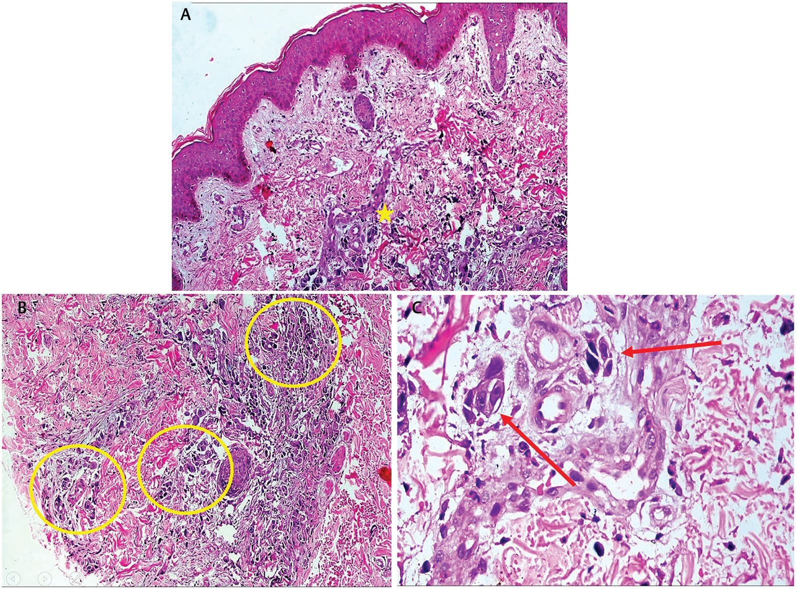 Fig. 4 (A) Skin biopsy reveals focal collections of intermediate-to-large sized cells in the dermis particularly around perivascular areas (yellow star; hematoxylin & eosin [H&E], 100x). (B) The malignant cells lying singly in small nests, attempting to form acini (yellow circle) (H&E, 200x). (C) Malignant cells are anaplastic with large irregular hyperchromatic nuclei (red arrow) (H&E, 400x).