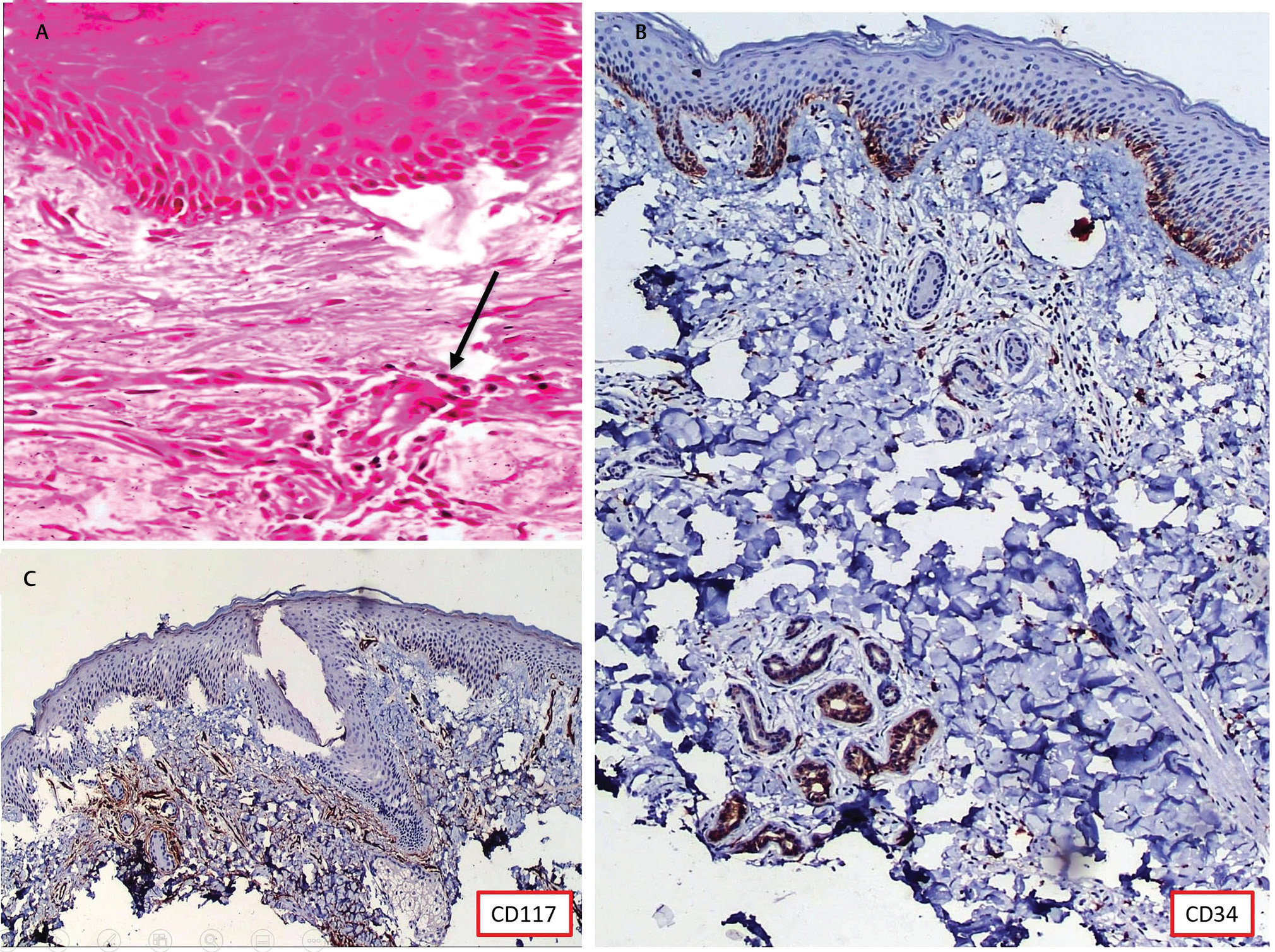 Fig. 6 (A) Dermis shows superficial dermal vessels with few extravasated large atypical cells (black arrow; hematoxylin & eosin [H&E] 400x). (B) Immunohistochemistry (IHC) CD34 positive (100x). (C) IHC CD117 positive (100x).
