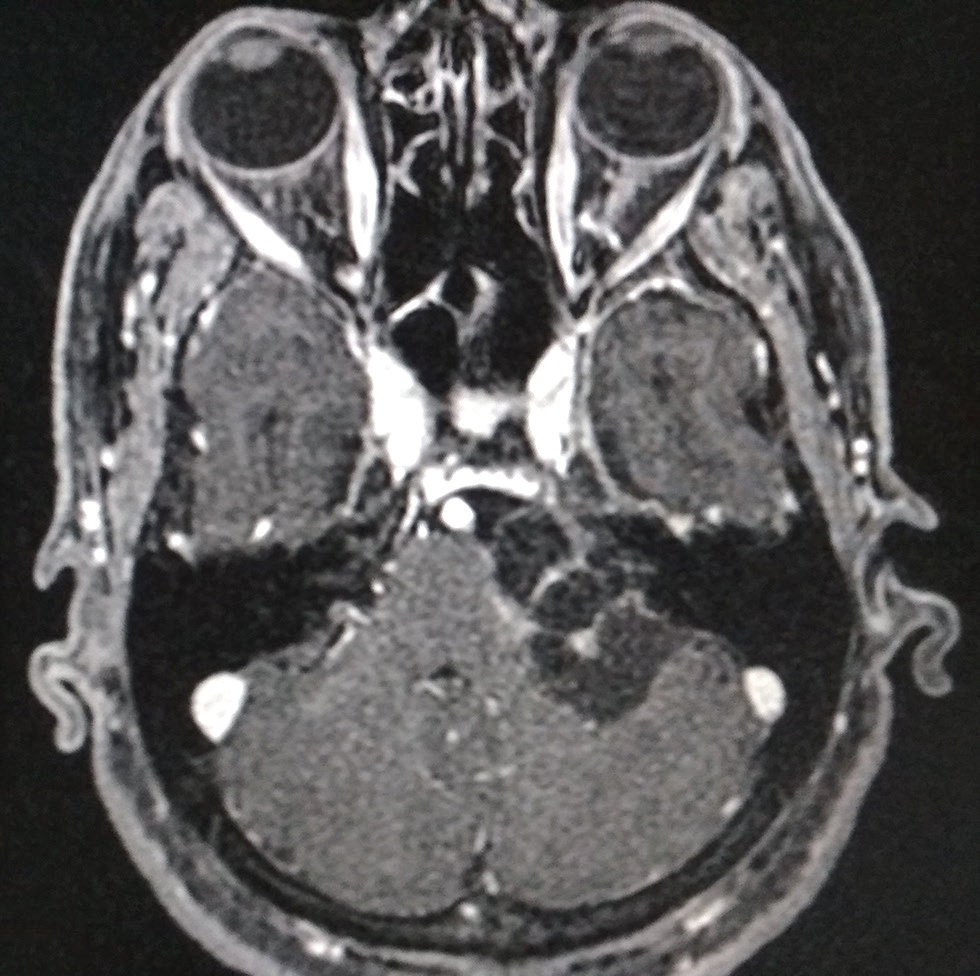 Fig. 1 Axial three-dimensional fat-suppressed magnetic resonance imaging with contrast of a 76-year-old female patient demonstrating a left-sided type-1B (Piccirillo’s classification) cystic vestibular schwannoma (star) causing significant mass effect on adjacent cerebellum, pons and cerebellar peduncle. Left vestibulocochlear, facial nerve complex root entry zone (origin), is masked by the lesion.