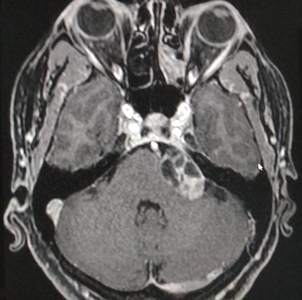 Fig. 2 Axial three-dimensional fat-suppressed magnetic resonance imaging with contrast of a 58-year-old female patient who presented with a left-sided tinnitus demonstrating a left sided type-1A (Piccirillo’s classification) cystic vestibular schwannoma (star) causing mass effect on the pons, cerebellar peduncle and VII–VIII nerve complex.