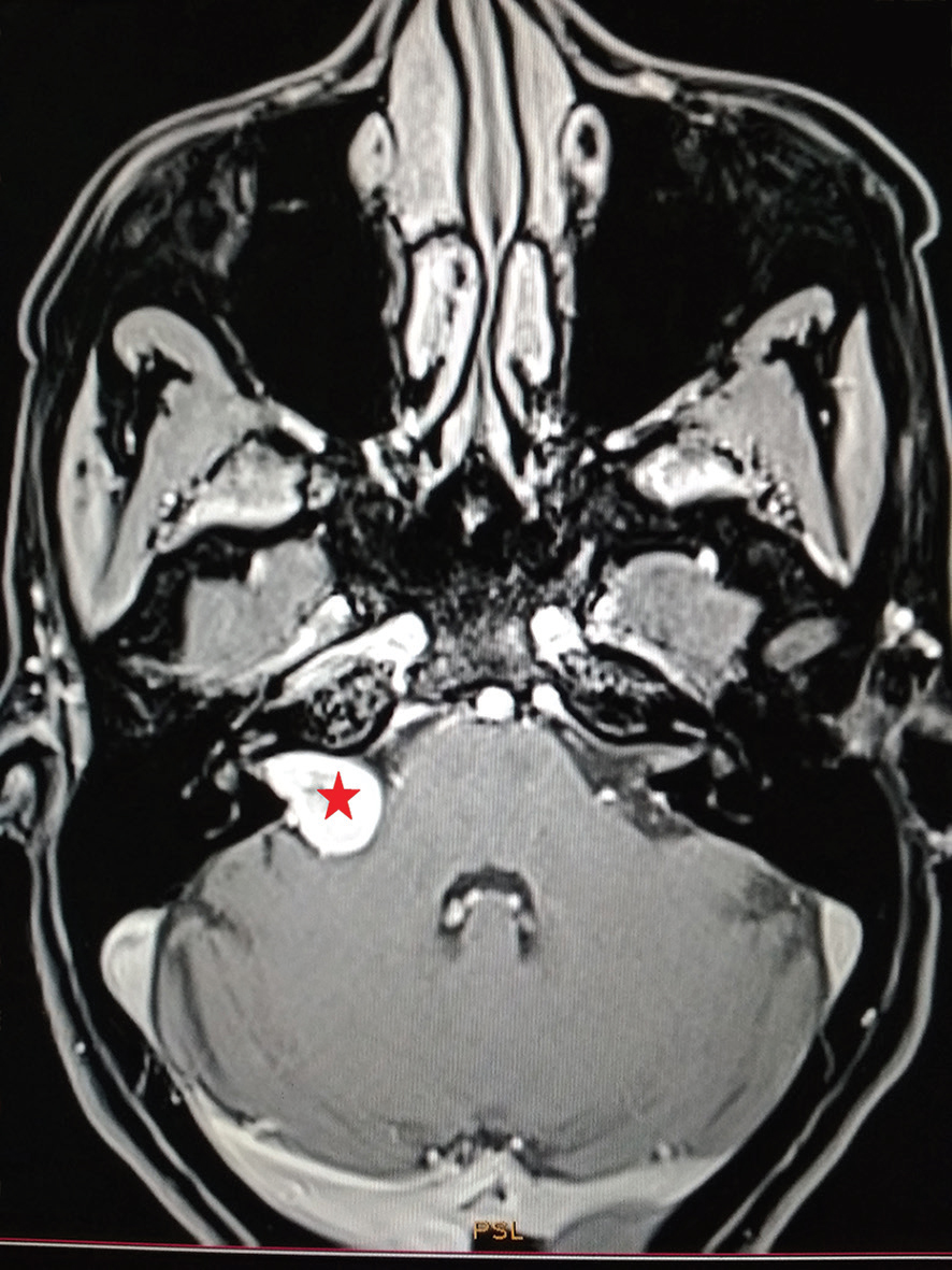 Fig. 3 Pre–GKRS axial volumetric interpolated breath-hold examination fat-suppressed magnetic resonance imaging image obtained in a 51-year-old female with tinnitus and imbalance demonstrating a right cerebellopontine angle vestibular schwannoma (star). GKRS, Gamma Knife radiosurgery.