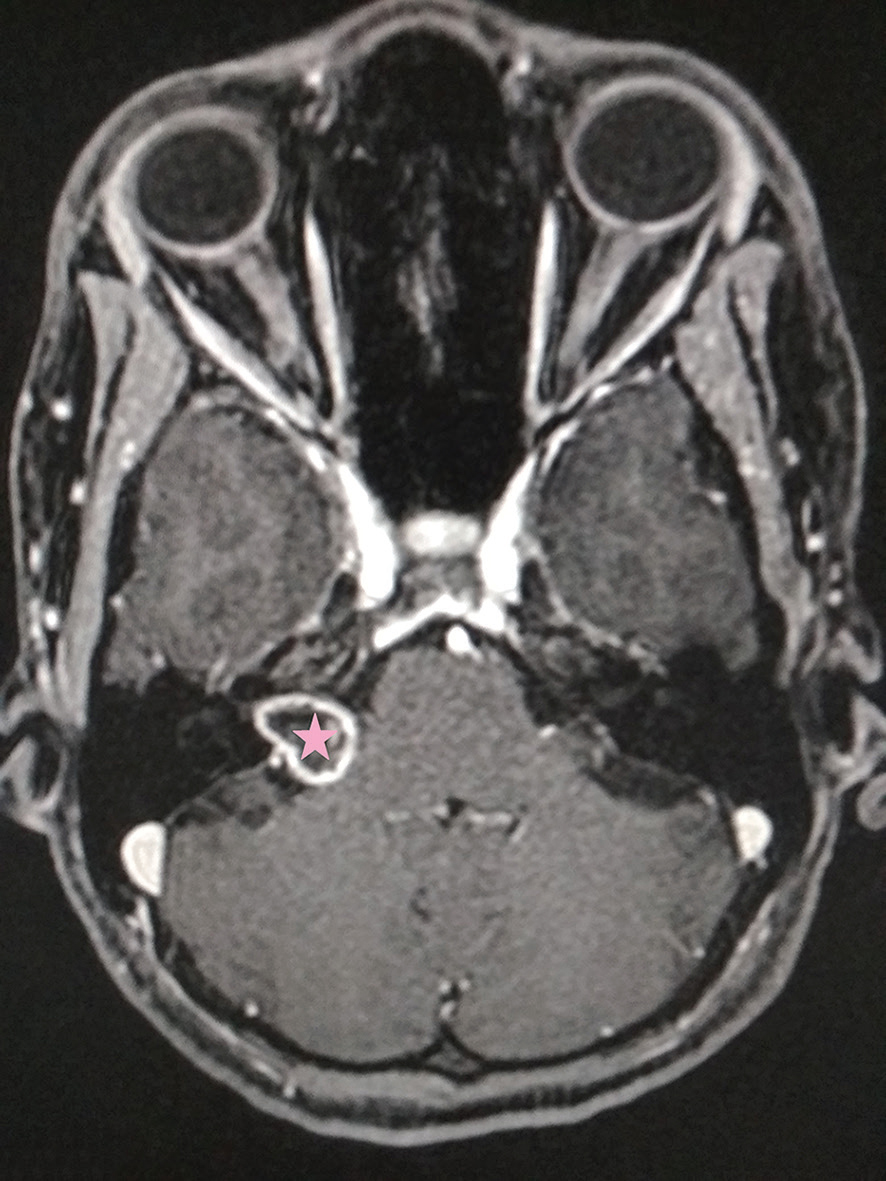 Fig. 4 Post–GKRS axial three-dimensional fat-suppressed magnetic resonance imaging image obtained 6 weeks later demonstrating a rim of peripheral enhancement with central necrosis in a right cerebellopontine angle vestibular schwannoma (star). GKRS, Gamma Knife radiosurgery.