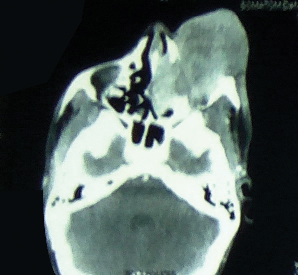 Fig. 2 CECT PNS (contrast-enhanced computed tomography and paranasal sinuses): axial View depicting lesion extending into left orbit and displacing the globe superolaterally with loss of fat plane.