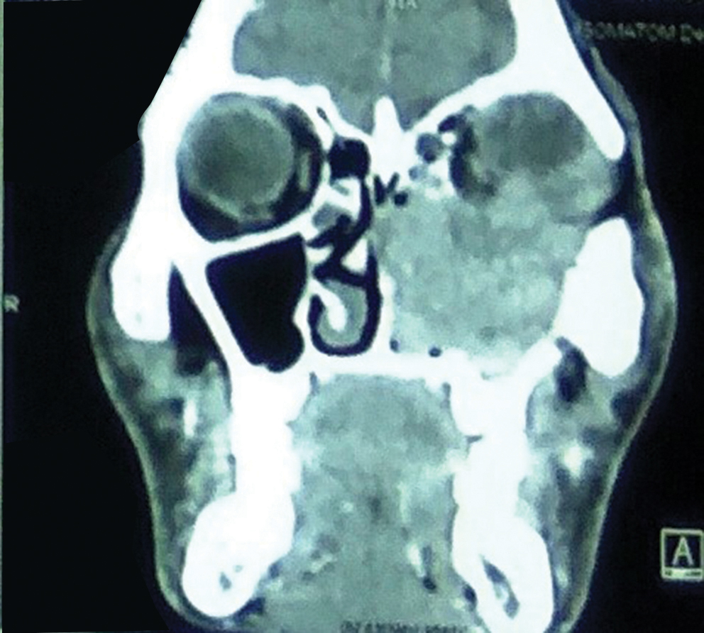 Fig. 3 CECT PNS (contrast-enhanced computed tomography and paranasal sinuses): corornal view showing the mass present medially involving left osteomeatal complex, turbinates, ethmoid air cells and lateral nasal wall and septum.