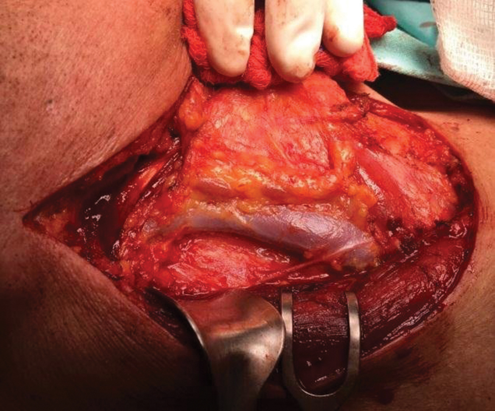 Fig. 5 Modified radical neck dissection type III.