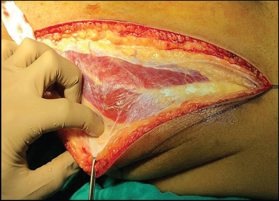 Fig. 7 Harvesting of anterolateral thigh flap.