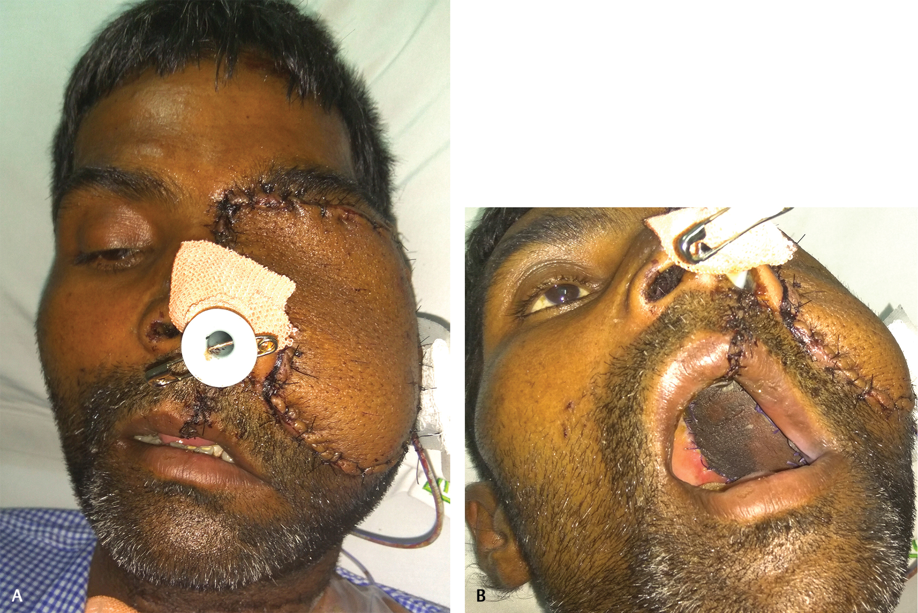 Fig. 8 (A, B) Postoperative extraoral view showing viable flap.