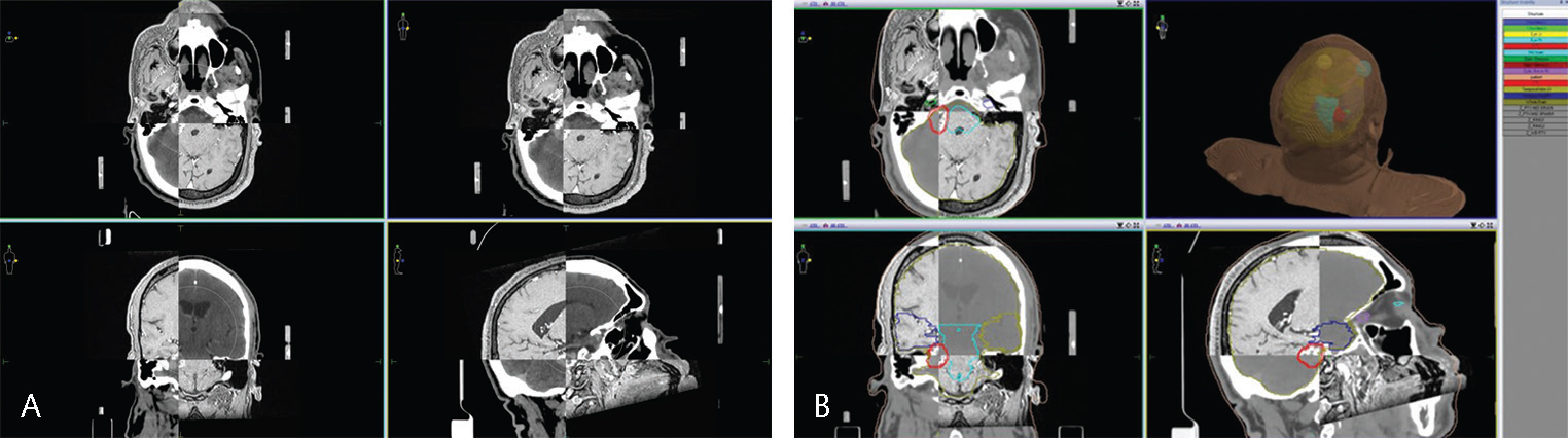 Fig. 4 (A) CT-MRI fusion. (B) Target volume and organ-at-risk delineation. CT-MRI, computed tomography–magnetic resonance imaging.