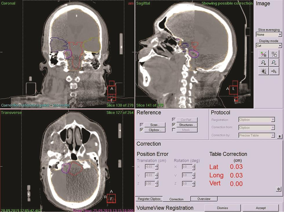 Fig. 8 CBCT fused with planning CT to assure submillimeter accuracy just before treatment. CBCT, cone beam computed tomography.