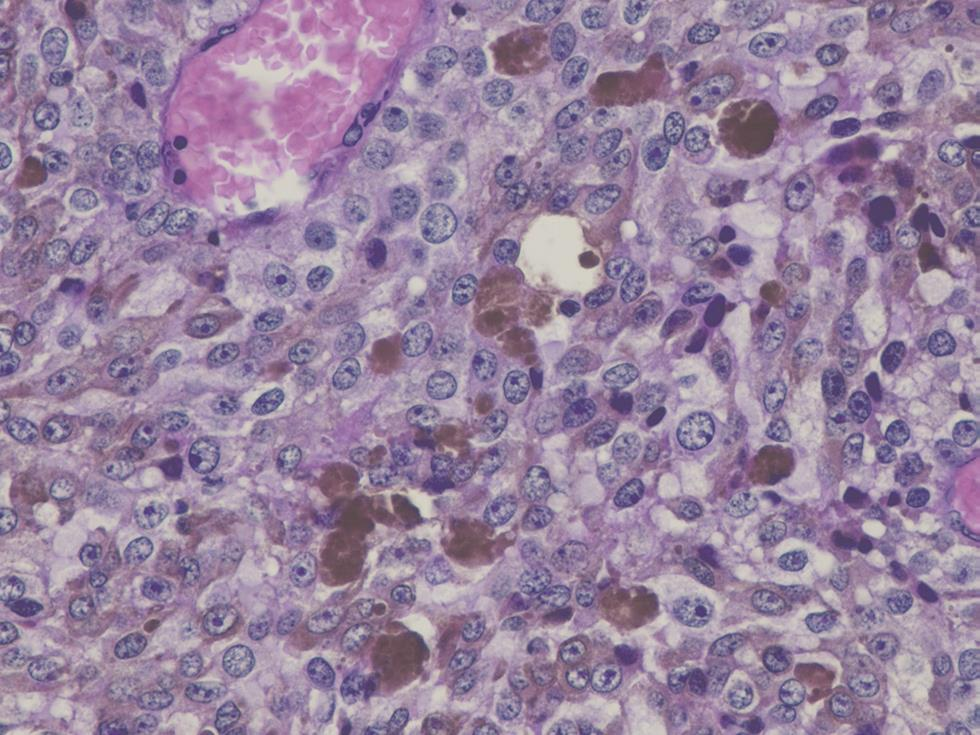 Fig. 1 Microscopic image of blade from anatomopathologist. Malignant tumor formation characterized by a diffuse cellular layer made up of a large element provided with a cytoplasm of variable abundance and contained significant melanic deposits: malignant melanoma.