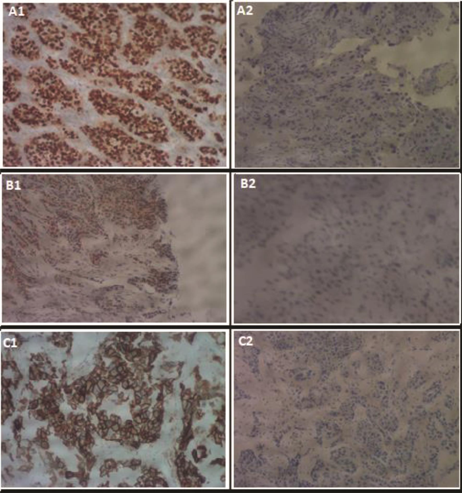 Fig. 4 (a1) Estrogen receptor (ER)–positive of invasive ductal carcinoma grade III 100×. (a2) ER-negative of invasive ductal carcinoma grade III 100×. (b1) Progesterone receptor (PR)–positive of infiltrating lobular carcinoma 100×. (b2) PR-negative of invasive ductal carcinoma, grade II 100×. (c1) Her-2/neu–positive 3+ of invasive ductal carcinoma, grade III 100×. (c2) Her-2/neu–negative of invasive ductal carcinoma grade III 100×.